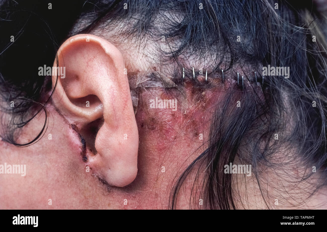 A close-up of the left side of a Caucasian woman's head a few weeks after a face-lift shows healing in progress following her cosmetic surgery. Fine stitches were used around the front part of her ear, while metal staples closed the skin under her hair. Using stainless steel surgical staples is faster than suturing an incision by hand with needle and thread, but stitches are preferred to avoid showing facial scars. The medical term for a face-lift is  rhytidectomy, a surgical procedure that is most often done to give the face a younger appearance. Stock Photo