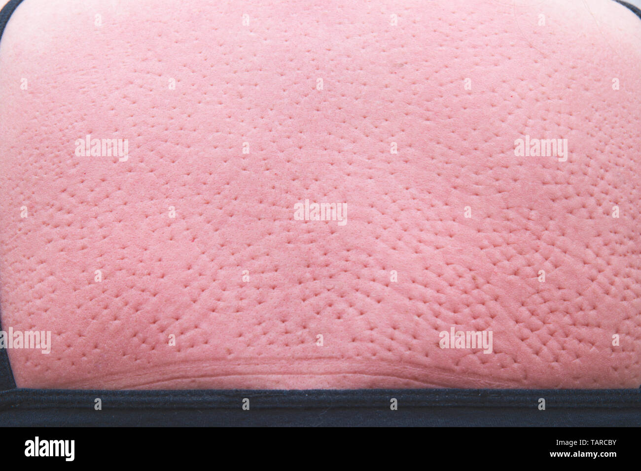 Pressure Marks Skin Stock Photos & Pressure Marks Skin Stock Images - Alamy