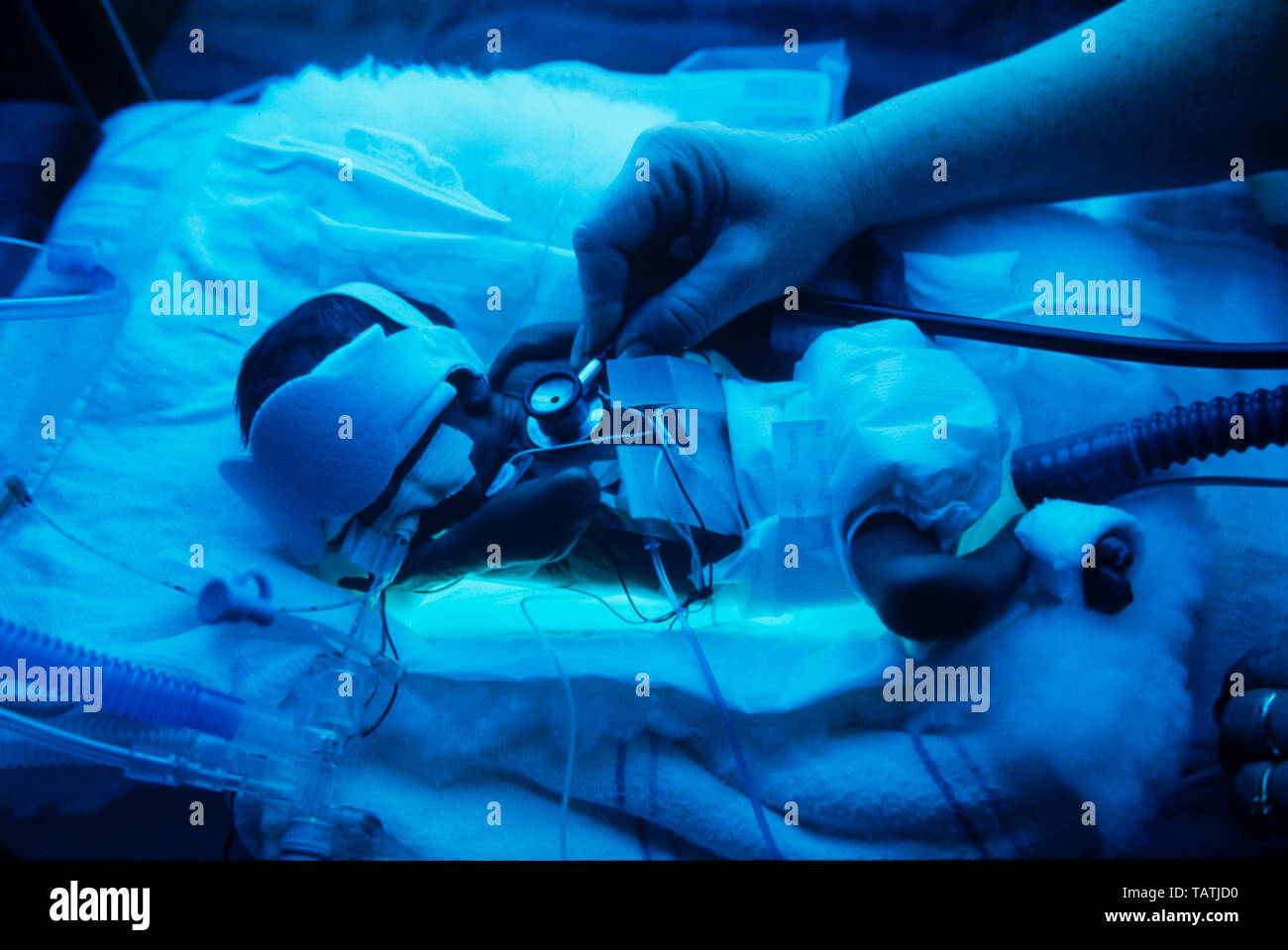 Bathed in blue ultraviolet light, a premature infant is monitored by a hospital  nursing staff Stock Photo