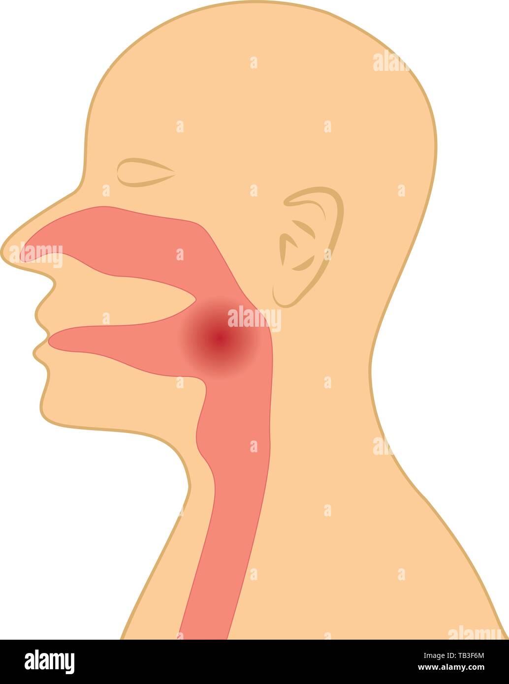 Sore throat because of flu virus influenza insperatory infection vector