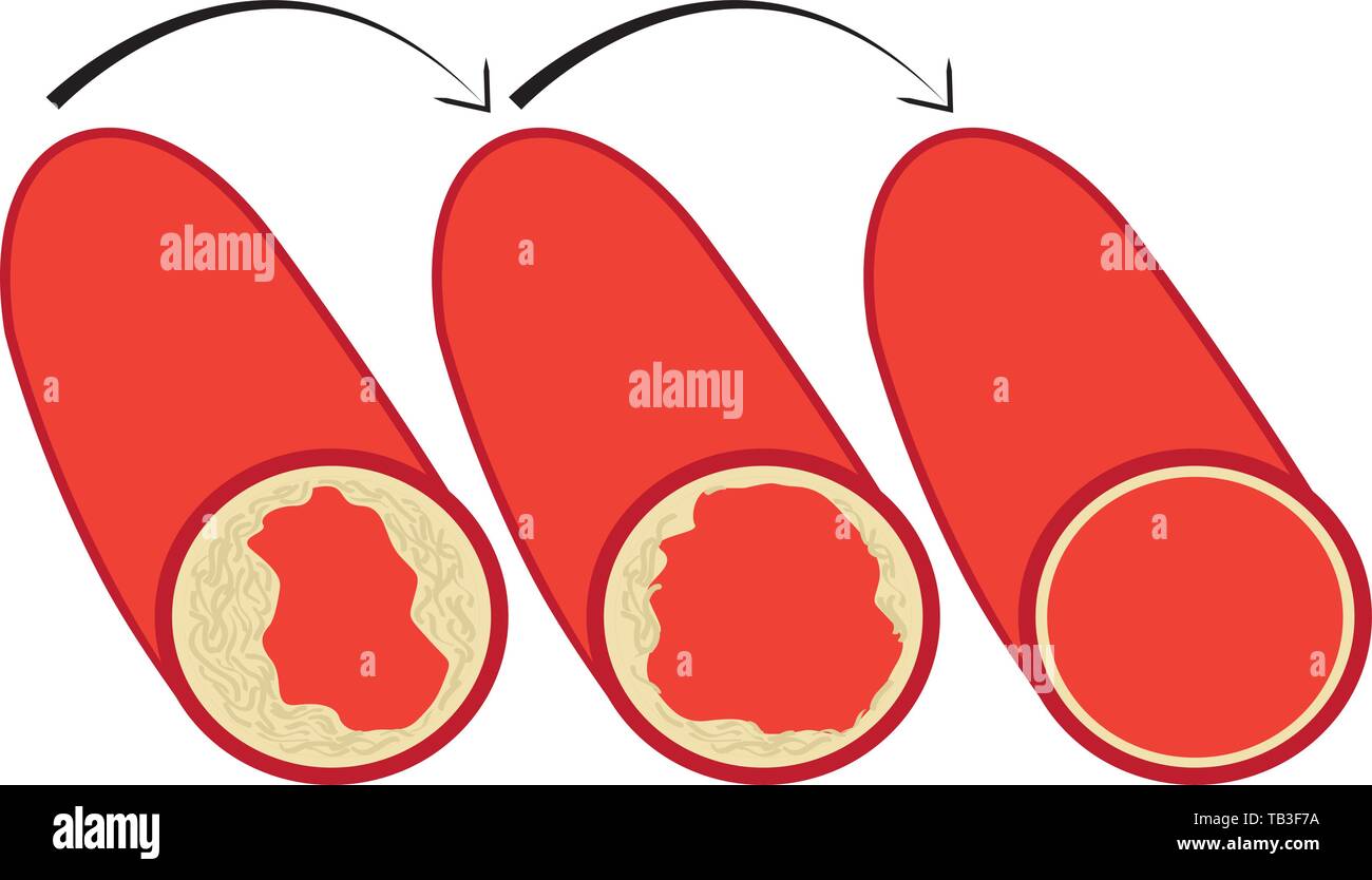 Reduce Levels of cholesterol plaque in vessels vector illustration on a ...