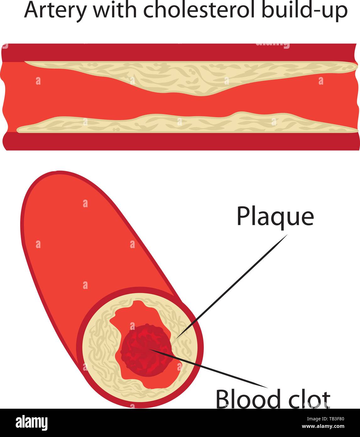 cholesterol plaque in artery vessels vector illustration Stock Vector