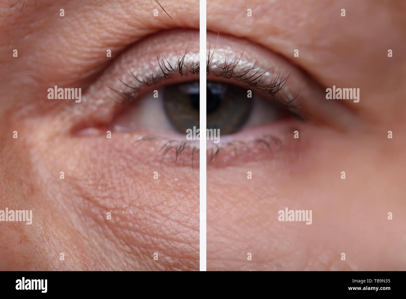 Close-up Of Woman's Eye Bags Before And After The Cosmetic Treatment Stock Photo
