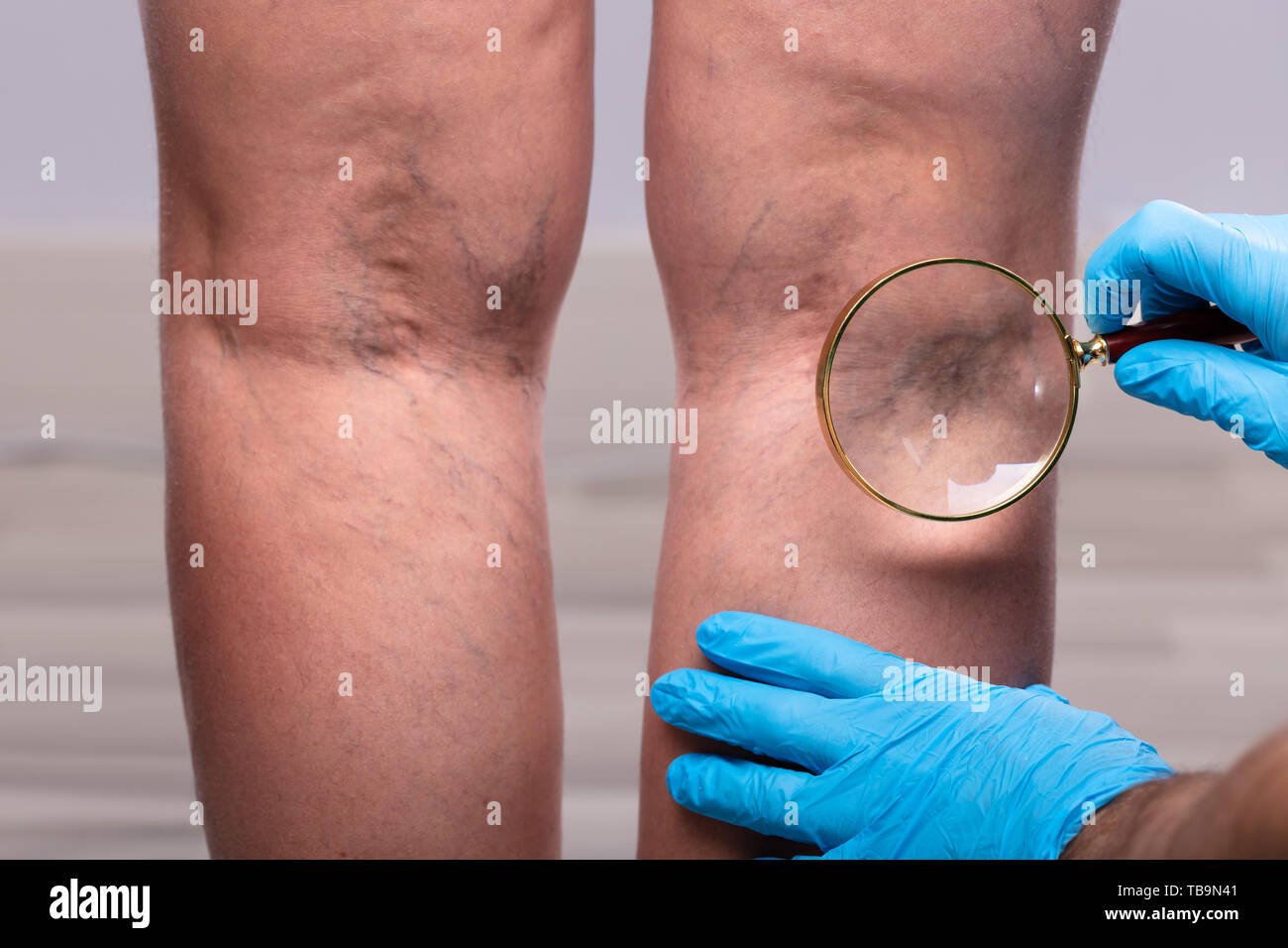 Close-up Of A Surgeon Wearing Blue Surgical Gloves Examining The Varicose Veins Through Magnifying Glass Stock Photo