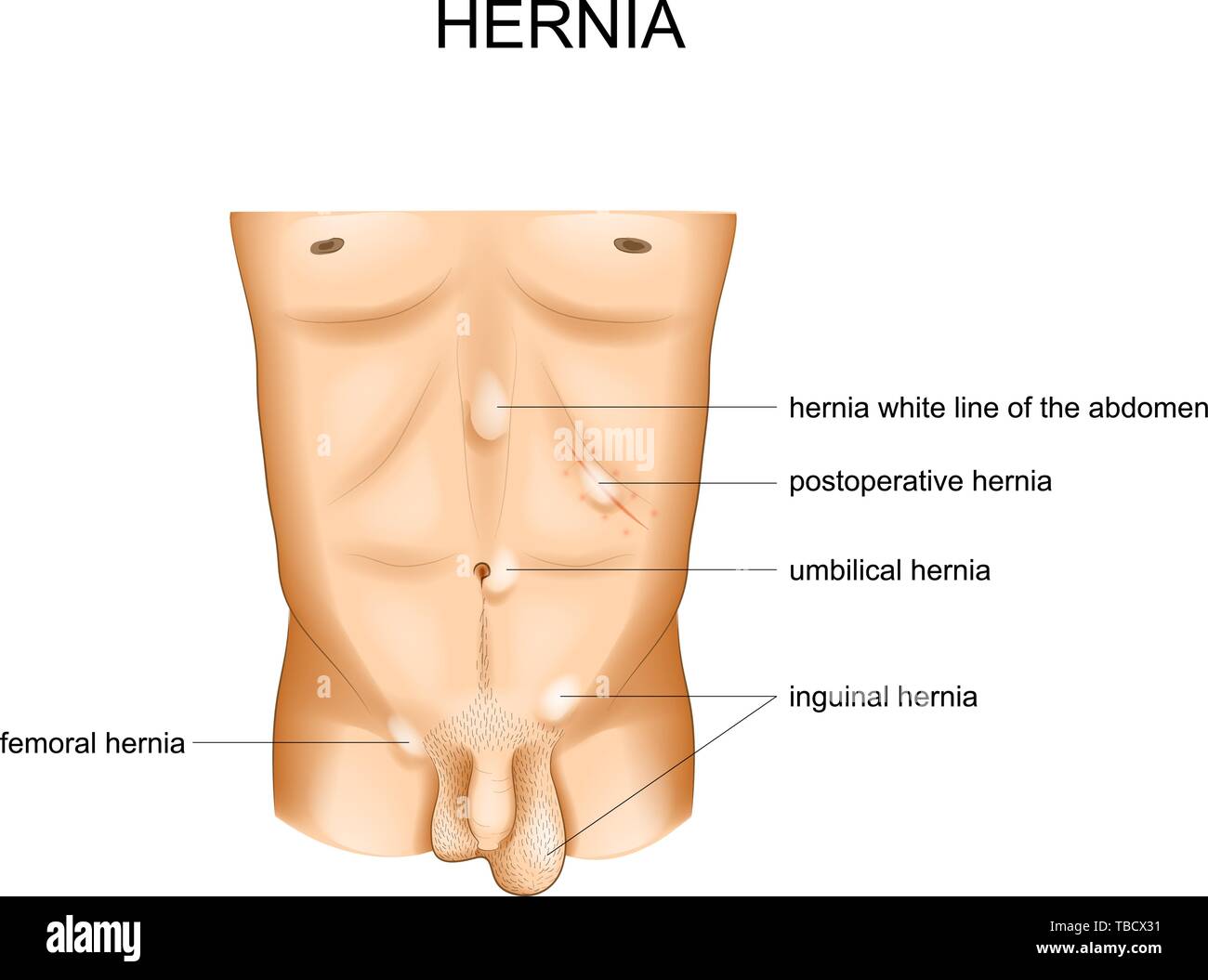vector illustration of hernia types by location Stock Vector