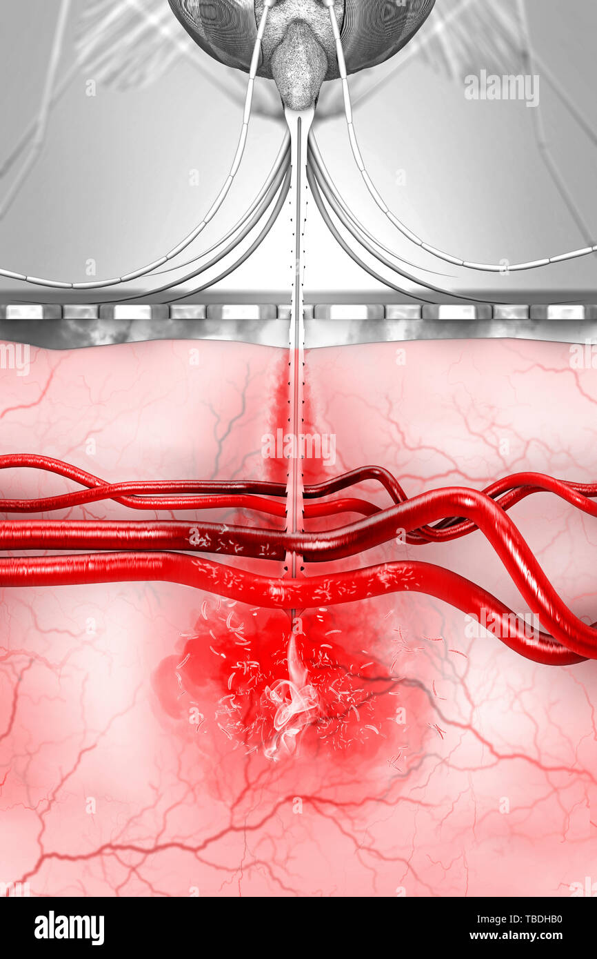 Malaria transmission, illustration. A malariainfected mosquito