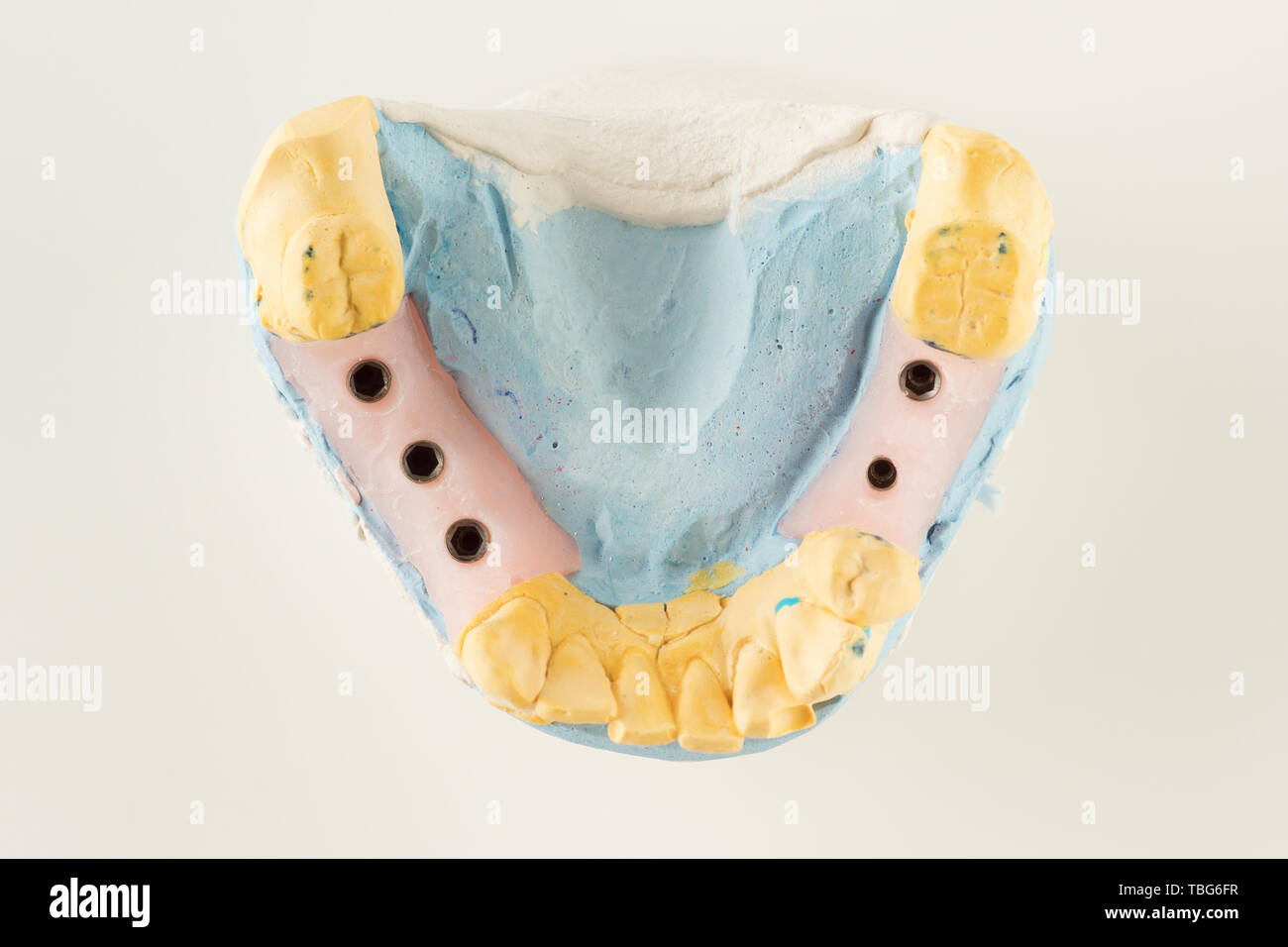 dental plaster model with artificial analogues of dental implants Stock