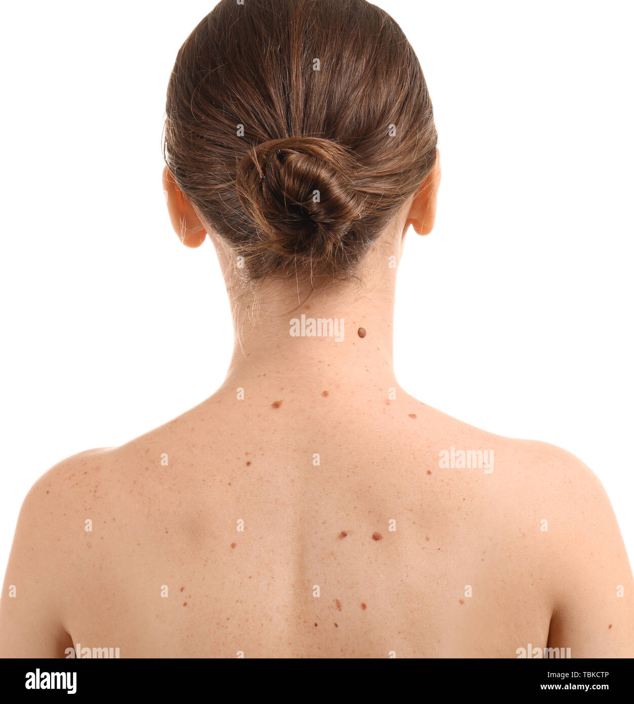 https://c8.alamy.com/comp/TBKCTP/young-woman-with-moles-on-white-background-TBKCTP.jpg