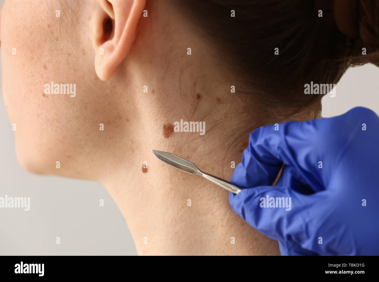 Doctor with lancet going to remove mole from patient's skin, closeup Stock Photo Alamy