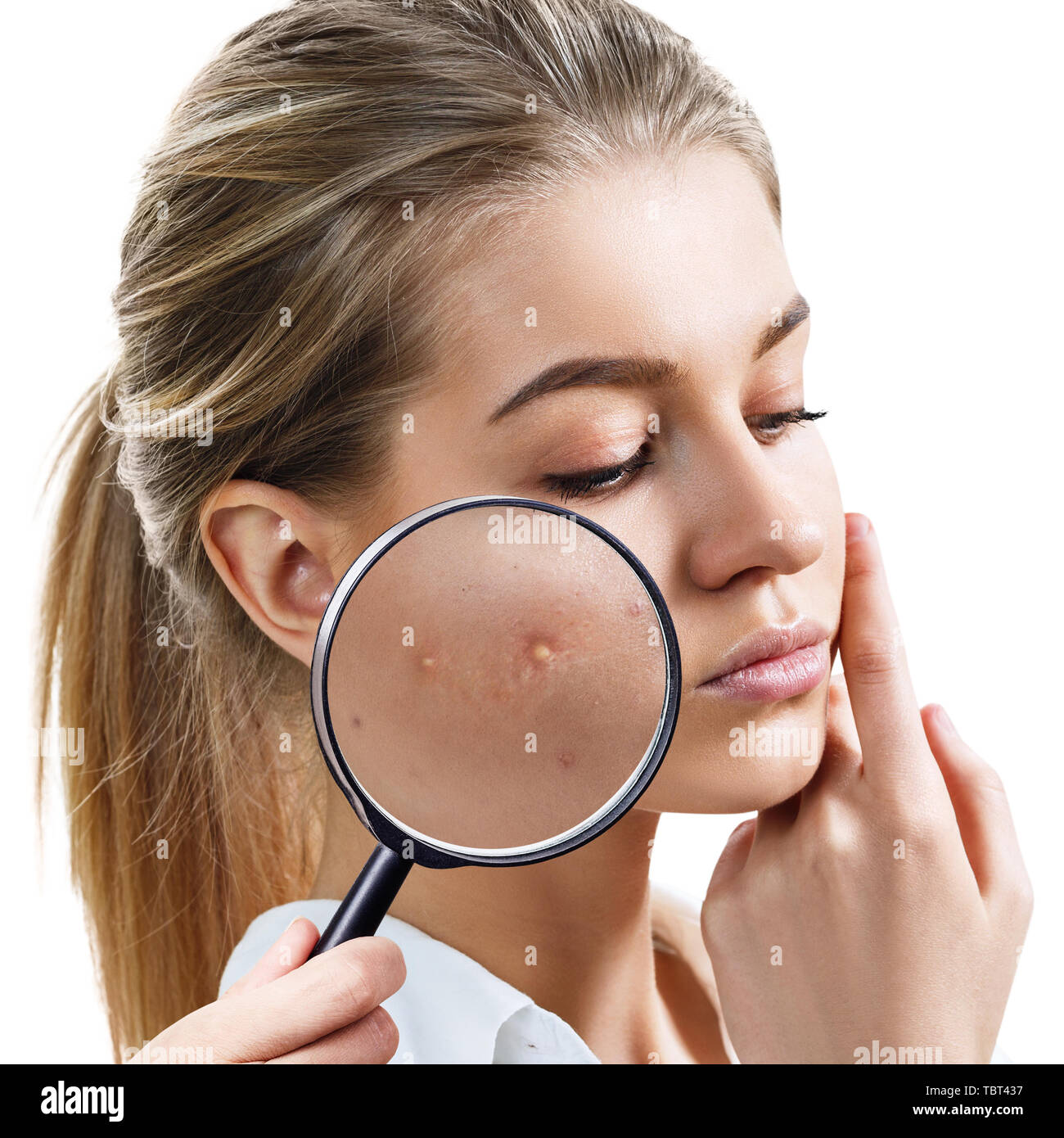 Young woman with magnifying glass shows skin with acne Stock Photo Alamy