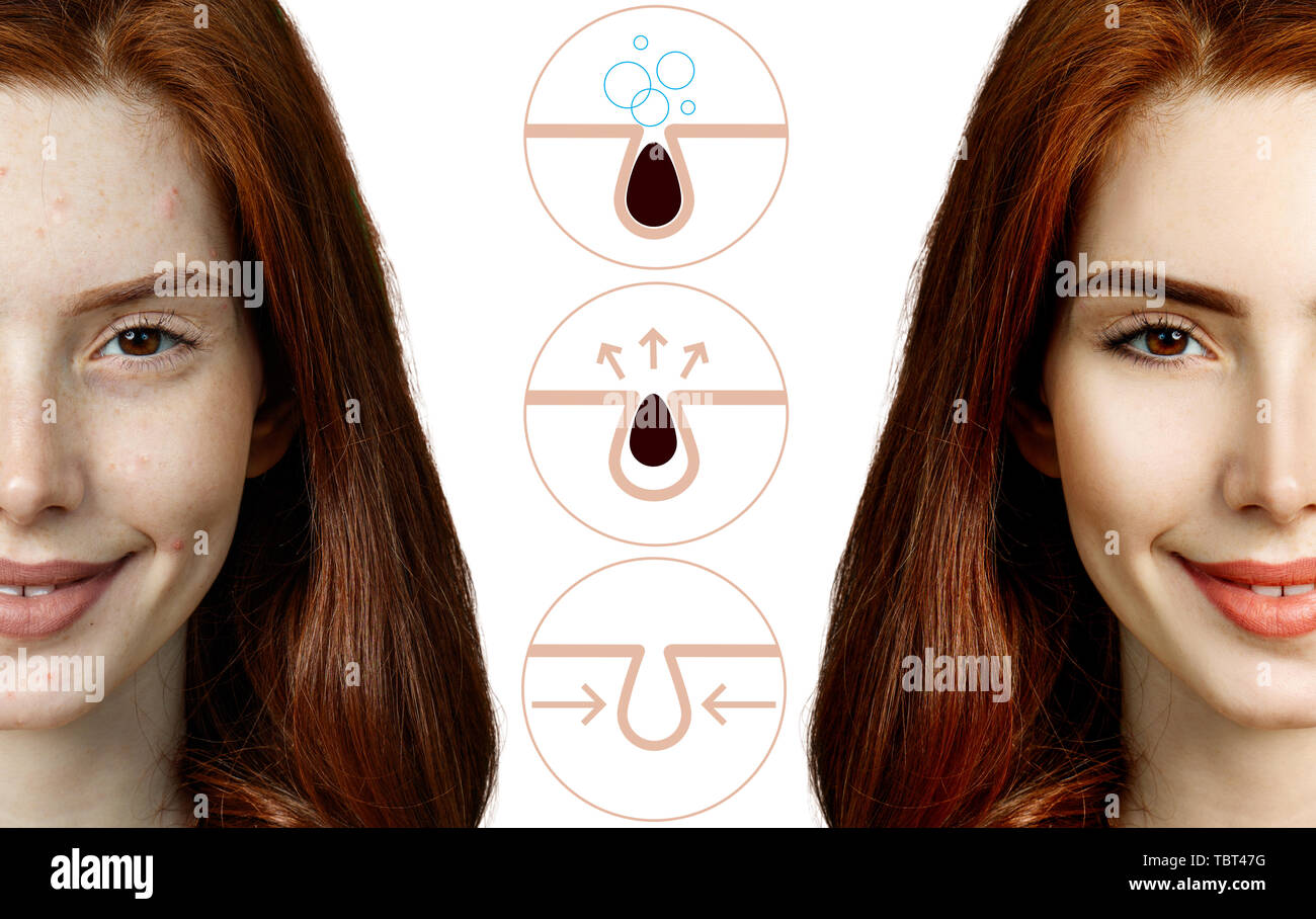 Woman shows how to pollute and clean the pores on face. Stock Photo