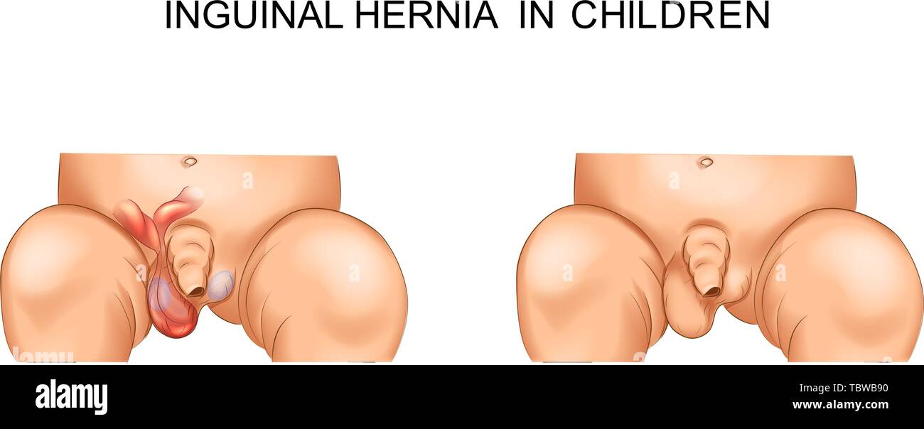 31 Umbilical Hernia Stock Photos, High-Res Pictures, and Images - Getty  Images