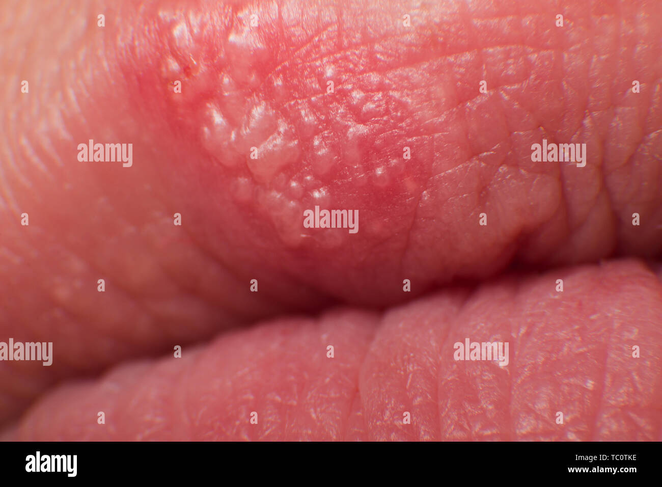 Herpes on lip hi res stock photography and images Alamy