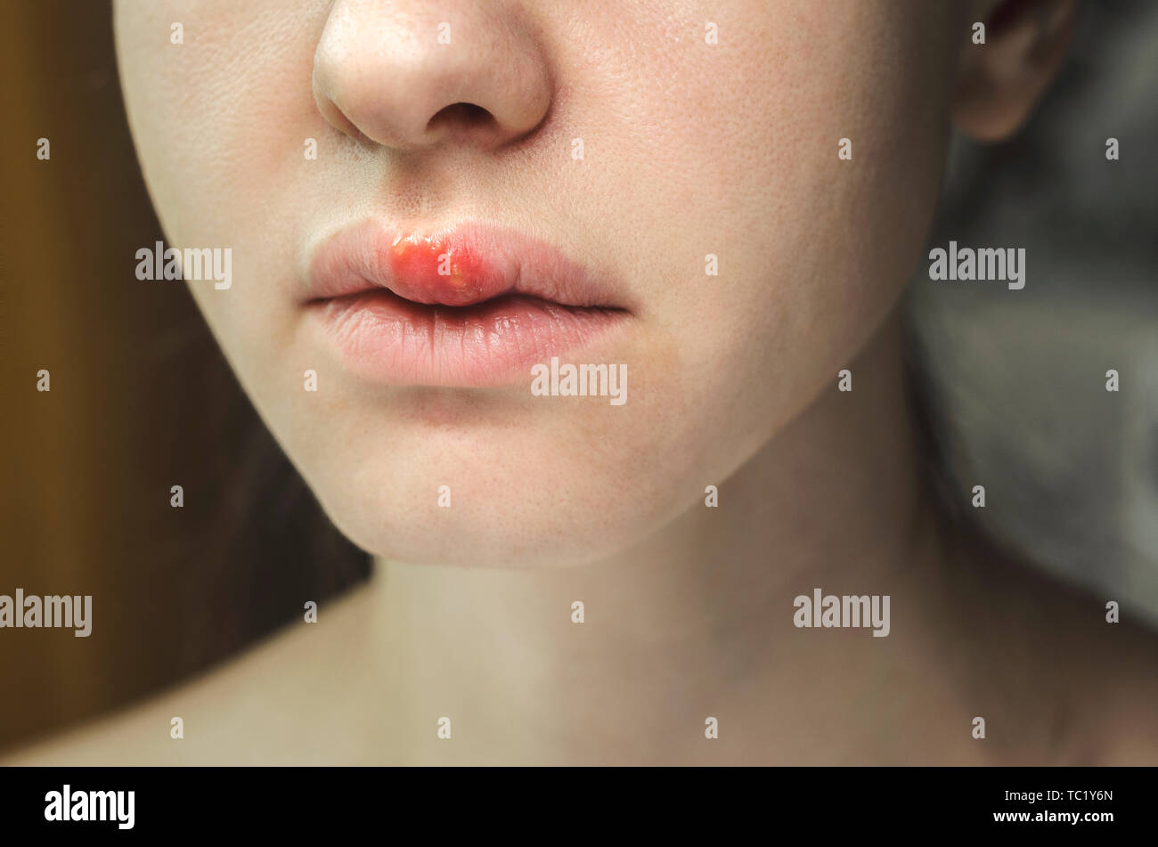 Herpes on the Upper Lip of a Young Woman. Medical Background of a Young