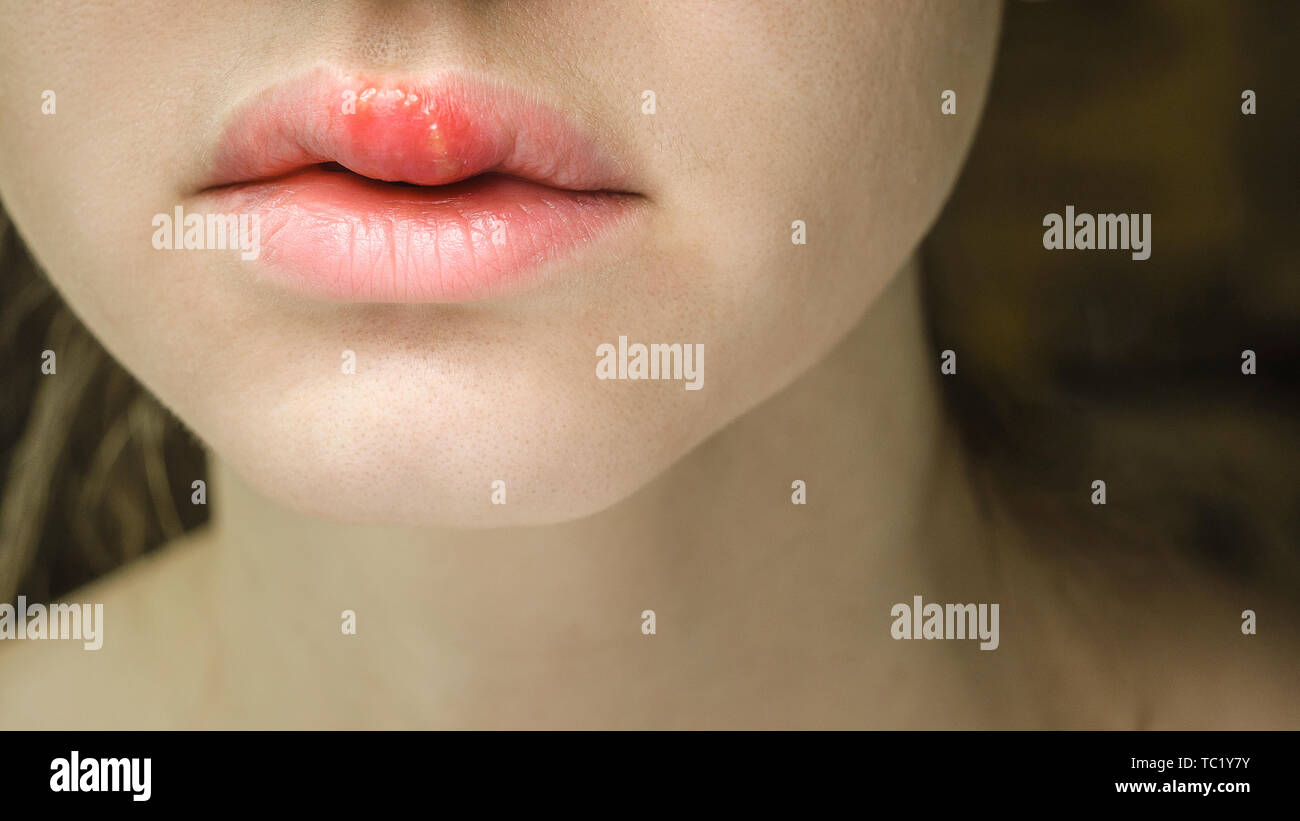 Herpes on the Upper Lip of a Young Woman. Medical Background of a Young Beautiful Girl with Herpes Labialis. Herpes Simplex Virus Stock Photo