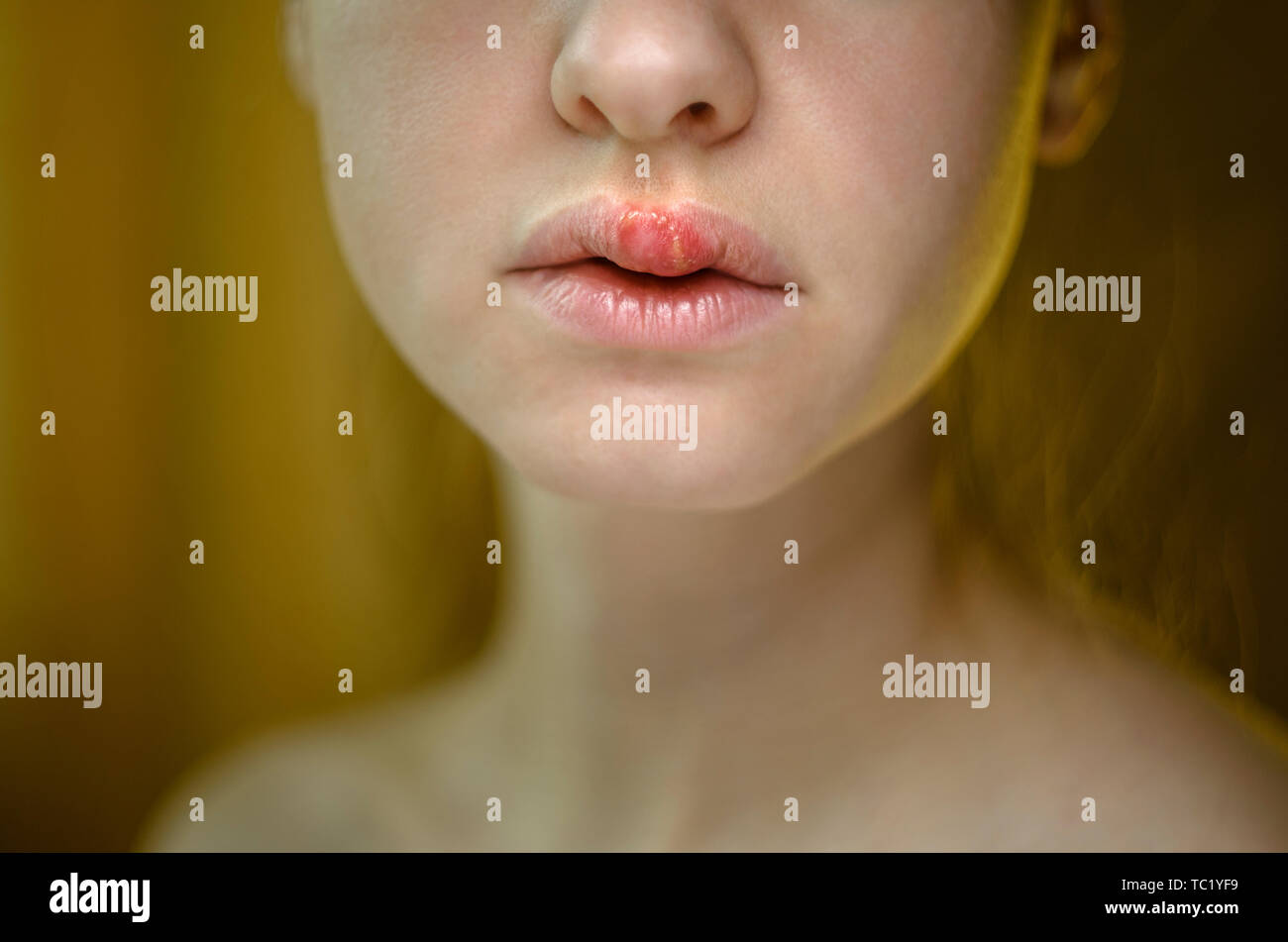 Herpes on the Upper Lip of a Young Woman. Medical Background of a Young