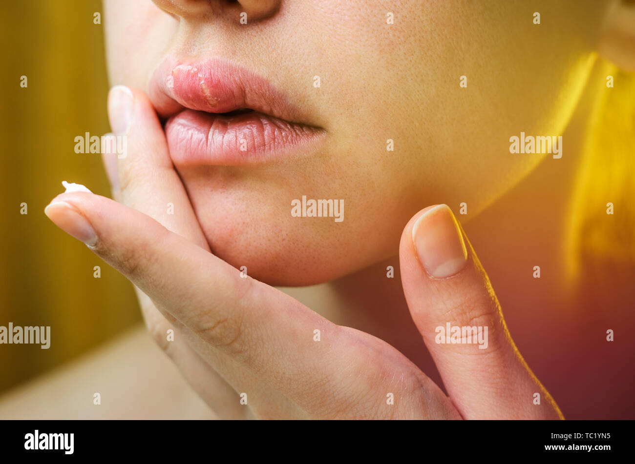 Woman Applying Ointment on Her Upper Lip with Herpes. Medical