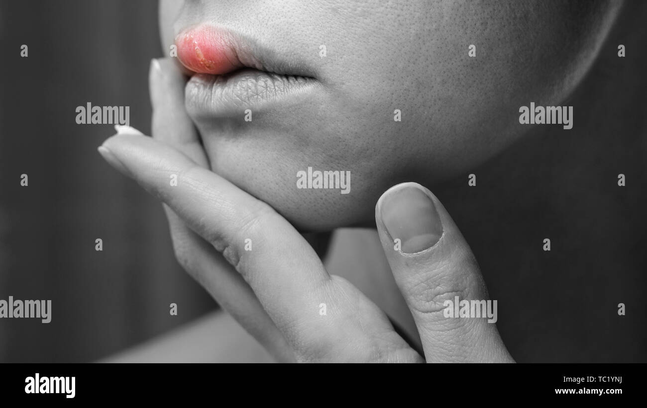 Woman Applying Ointment on Her Upper Lip with Herpes. Treatment of