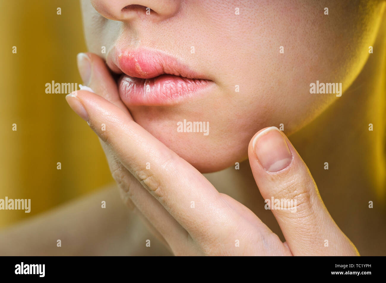 Woman Applying Ointment on Her Upper Lip with Herpes. Medical