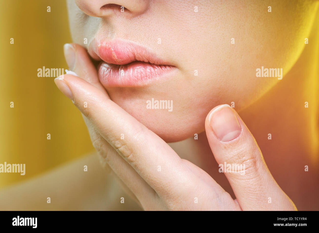 Woman Applying Ointment on Her Upper Lip with Herpes. Medical