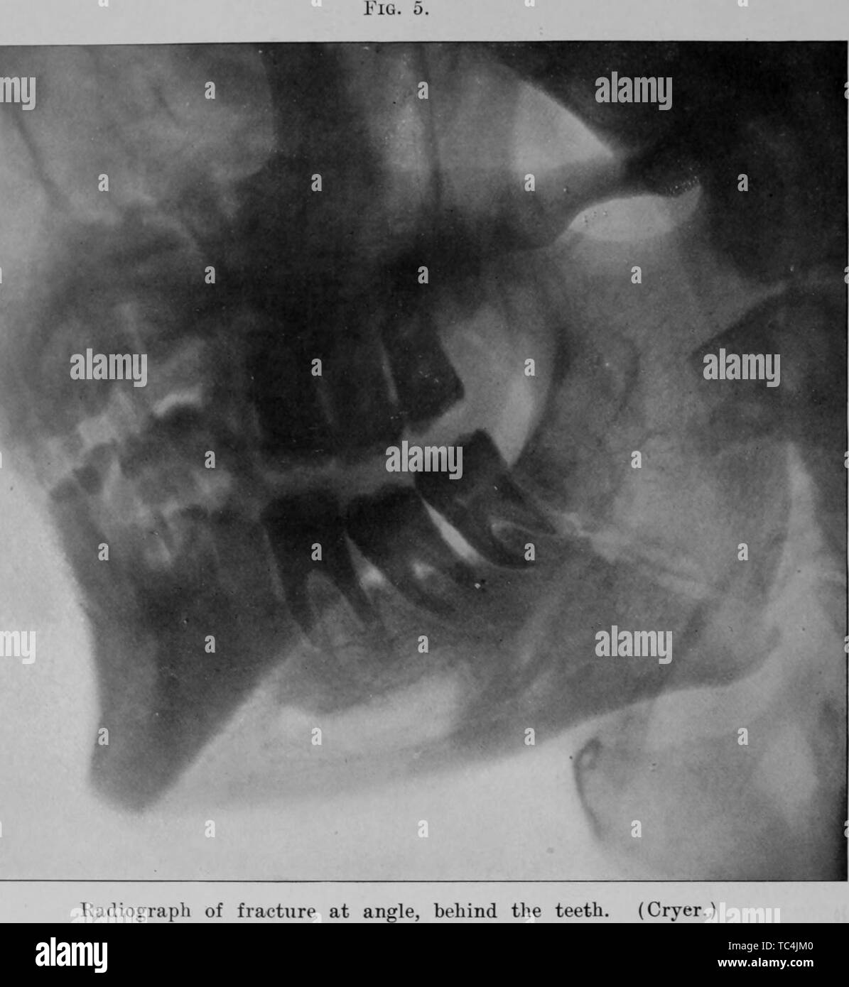 Radiograph of fracture at the angle, behind the teeth, from the book 'The Dental cosmos' by John Hugh McQuillen, George Jacob Ziegler, James William White, Edward Cameron Kirk, and Lovick Pierce Anthony, 1914. Courtesy Internet Archive. () Stock Photo