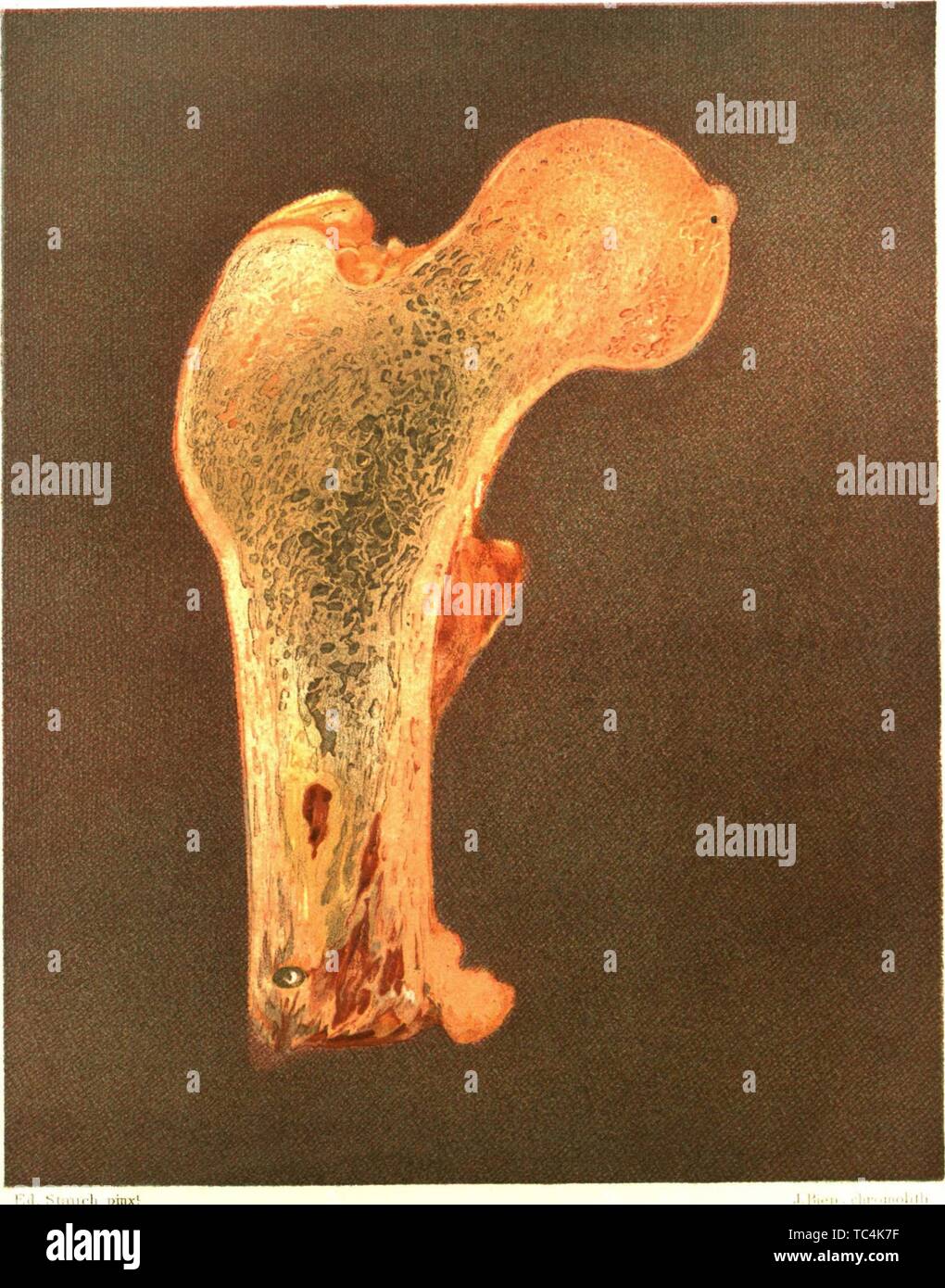 Osteomyelitis hires stock photography and images Alamy