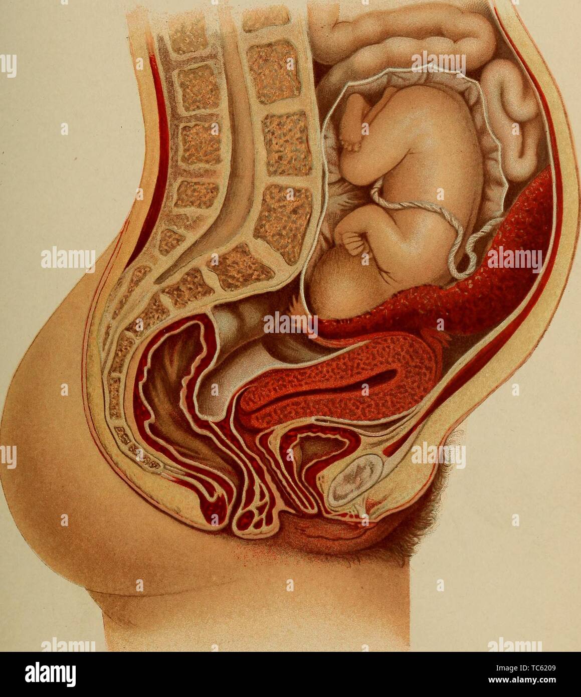 Illustration of the secondary abdominal pregnancy at eight months, from the book 'The diagnosis of diseases of women' by Findley Palmer, 1905. Courtesy Internet Archive. () Stock Photo