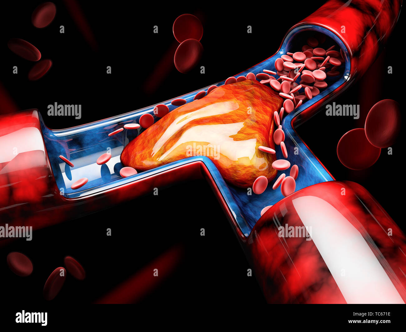 Embolism And Blood Clot High Resolution Stock Photography and Images