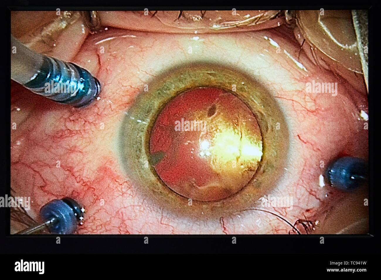 Image of the eye, Surgical intervention of eyes, Cataracts, Operating theater of ophthalmology, Hospital Donostia, San Sebastian, Gipuzkoa, Basque Stock Photo