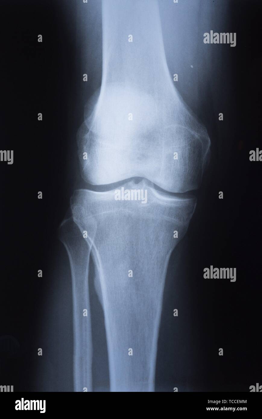 medical X ray image of knee. Radiography. Stock Photo