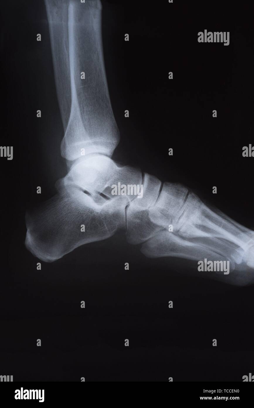Medical X ray image of foot. Radiography. Stock Photo