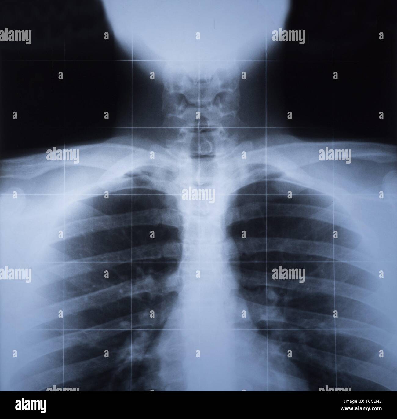 X ray image of human thorax. Radiography. Stock Photo