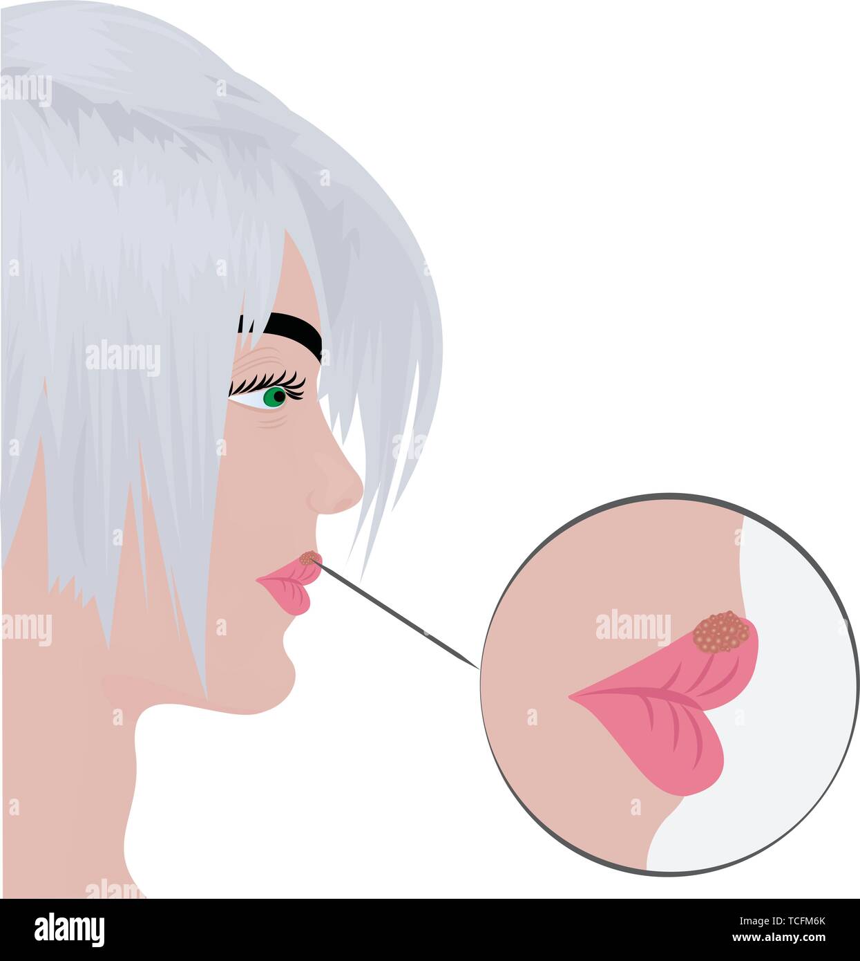 Herpes cold sores on woman's  lips vector illustration on a white background isolated Stock Vector