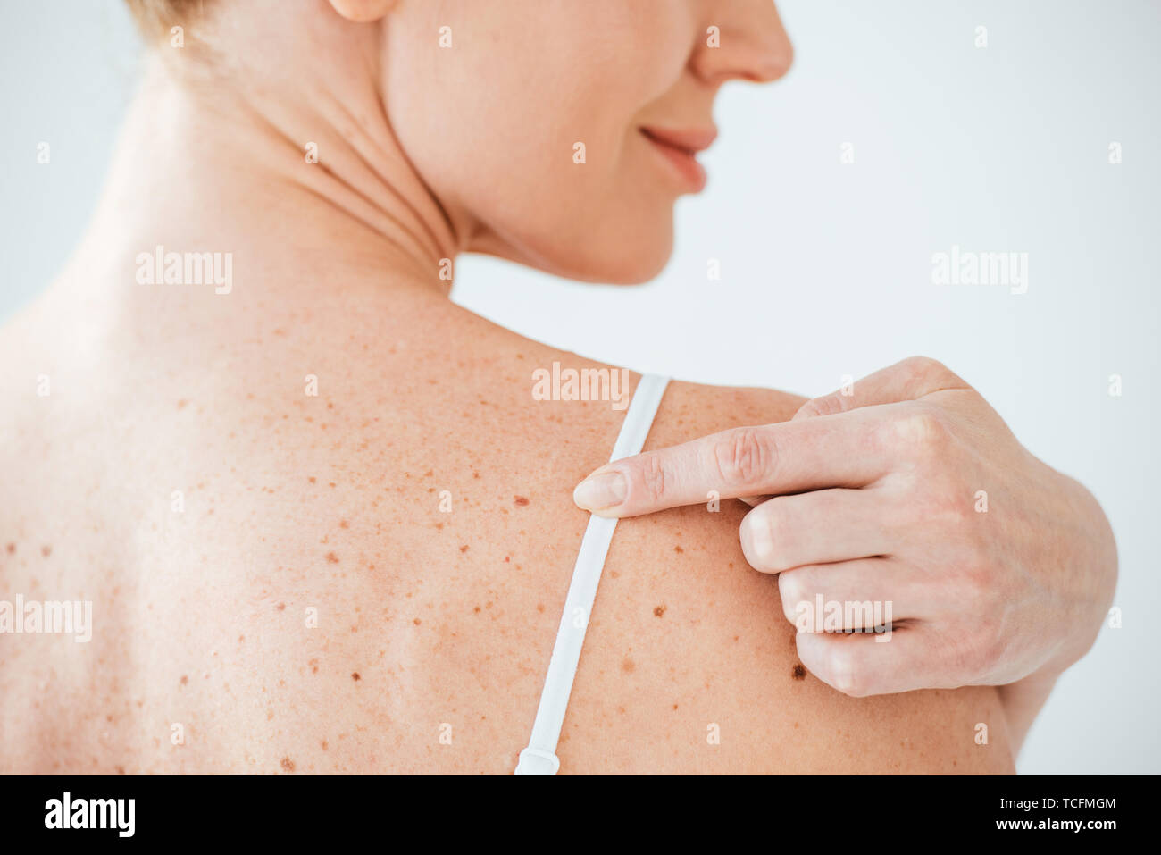 A skin tag or acrochordon on a person's buttocks Stock Photo - Alamy