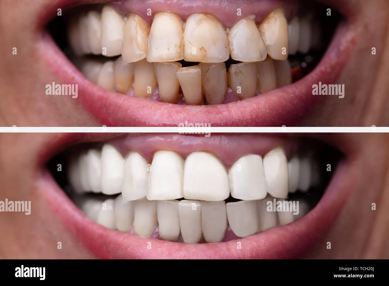 Female Teeth Between Before And After Dental Treatment Stock Photo