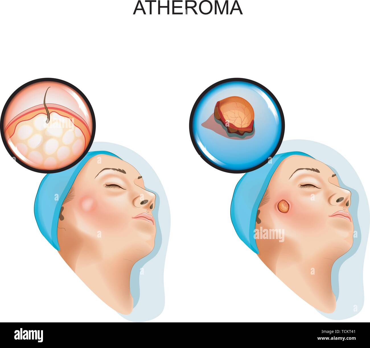 vector illustration of surgery of benign tumors of atheroma Stock Vector
