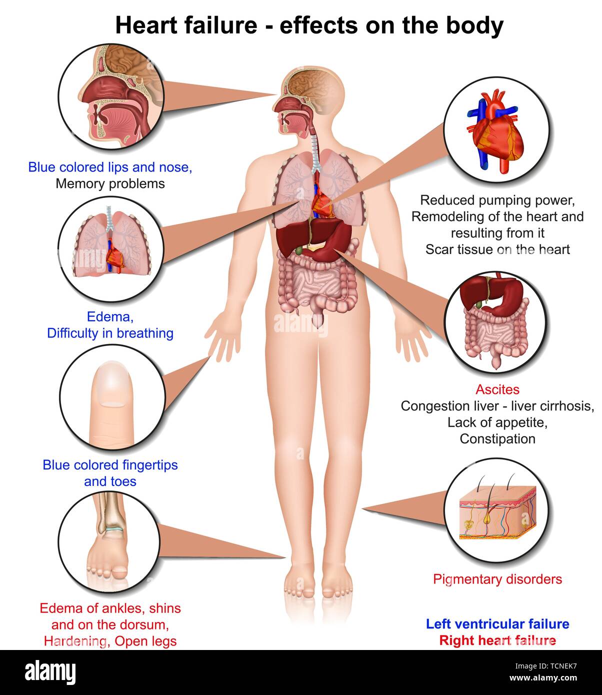 Hearth failure effects of the body 3d medical vector illustration on white background, infographic Stock Vector