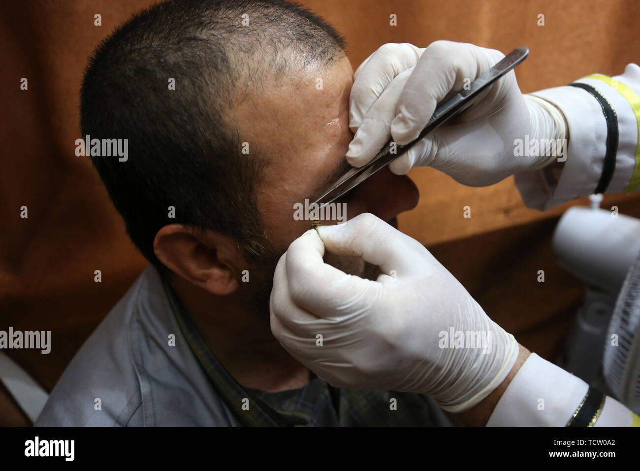 June 10, 2019 - Gaza City, Gaza Strip, Palestinian Territory - A Palestinian patient receives a bee-sting therapy by a health practitioner at a clinic in Gaza city on June 10, 2019. Apitherapy is the use of substances from honeybees, such as honey, propolis, royal jelly, or even venom (extracted or from live bees), to relieve various medical conditions. Most claims of apitherapy the medical use of bee venom are anecdotal and have not been proved to the satisfaction of scientists, although believers say it helps relieve pain from multiple sclerosis and rheumatoid arthritis and certain other ail Stock Photo