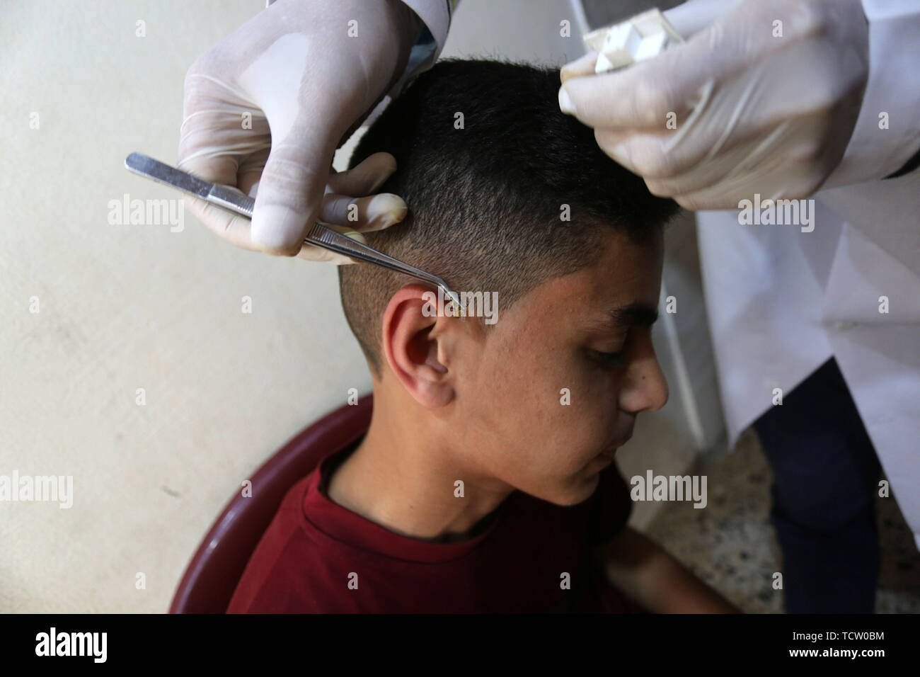 June 10, 2019 - Gaza City, Gaza Strip, Palestinian Territory - A Palestinian patient receives a bee-sting therapy by a health practitioner at a clinic in Gaza city on June 10, 2019. Apitherapy is the use of substances from honeybees, such as honey, propolis, royal jelly, or even venom (extracted or from live bees), to relieve various medical conditions. Most claims of apitherapy the medical use of bee venom are anecdotal and have not been proved to the satisfaction of scientists, although believers say it helps relieve pain from multiple sclerosis and rheumatoid arthritis and certain other ail Stock Photo