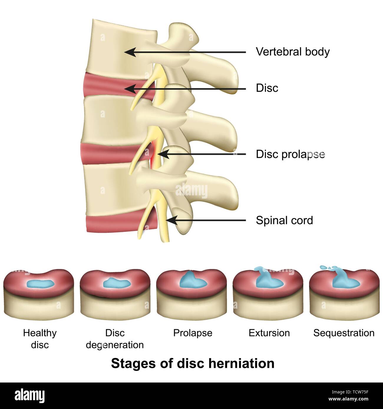 Stages of disc herniation spine and disc anatomy 3d medical vector illustration eps 10 Stock Vector