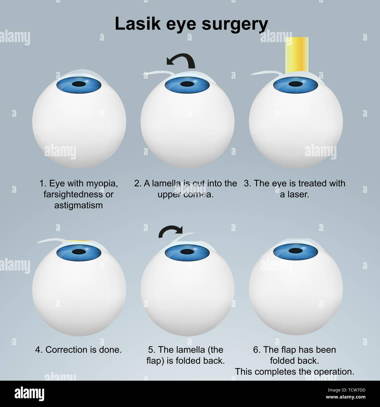 Laser eye surgery and illustration hi-res stock photography images -