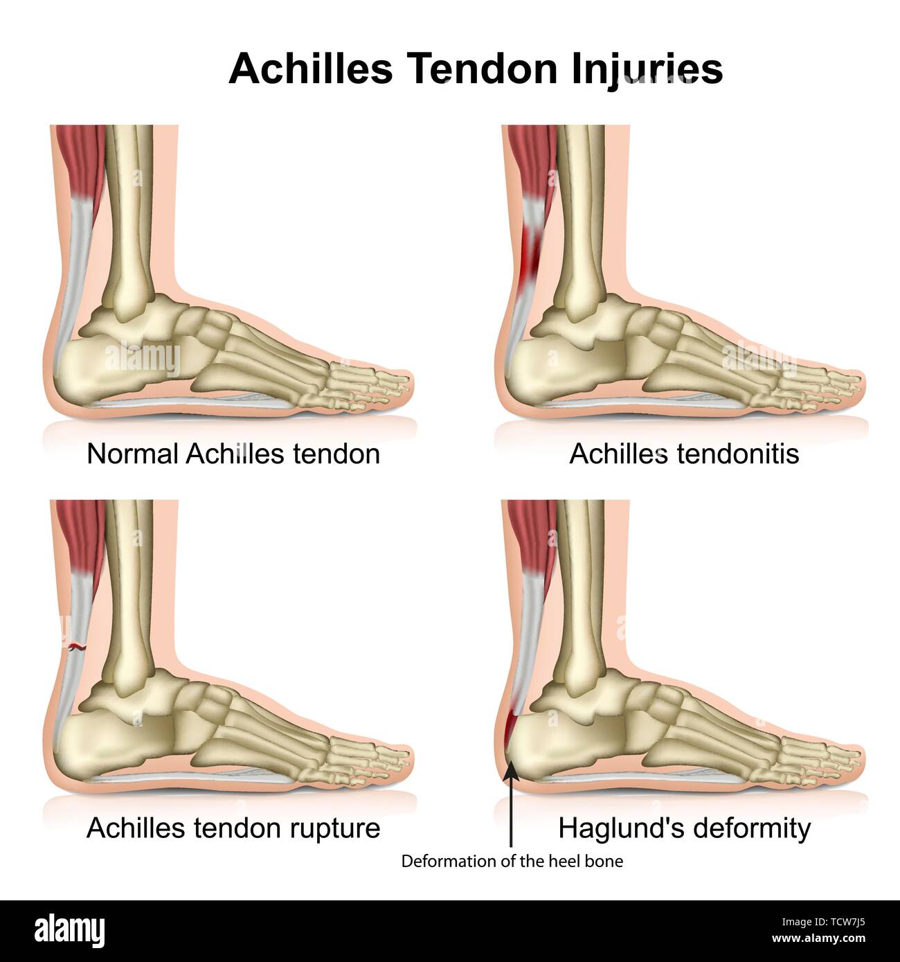 Inflammation Of Achilles Tendon Clearance Discount, Save 60% | jlcatj ...