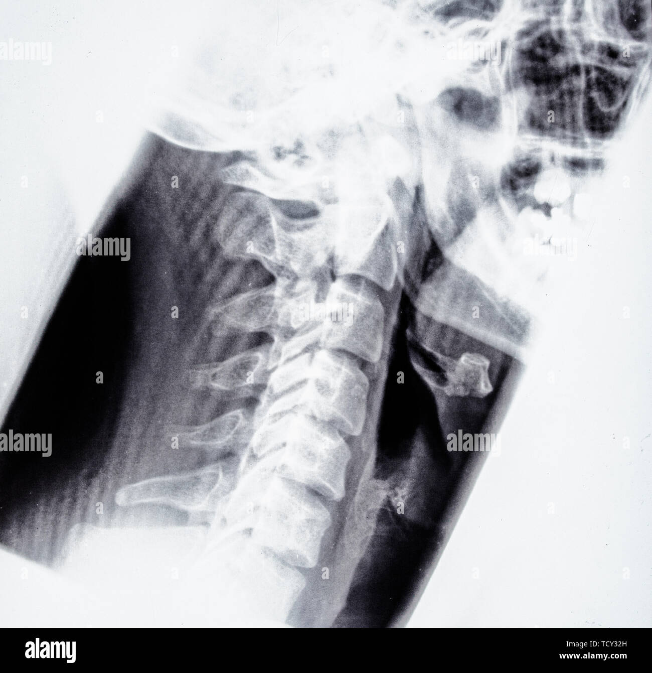 X ray head neck hires stock photography and images Alamy