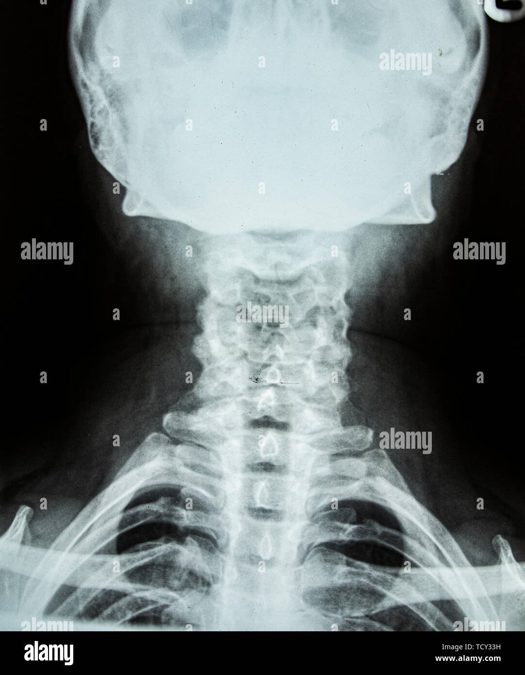 X ray head neck hires stock photography and images Alamy