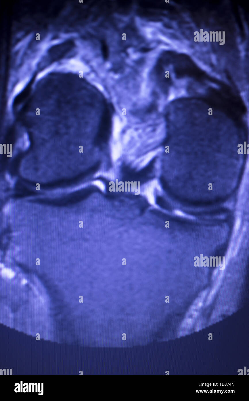 Magnetic Resonance Imaging Mri Knee Posterior Horn Medial Meniscus Tear 