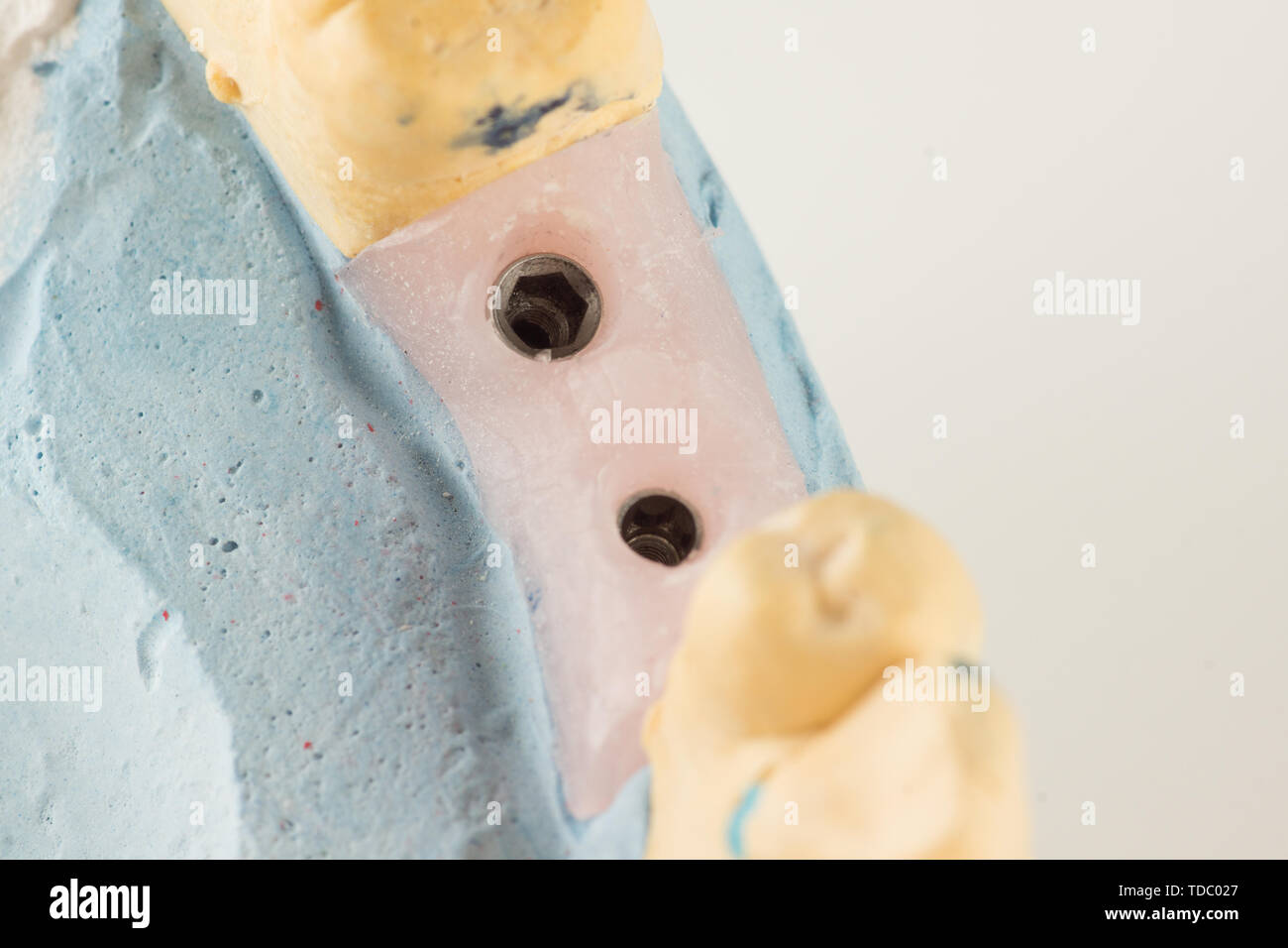 dental plaster model with artificial analogues of dental implants Stock