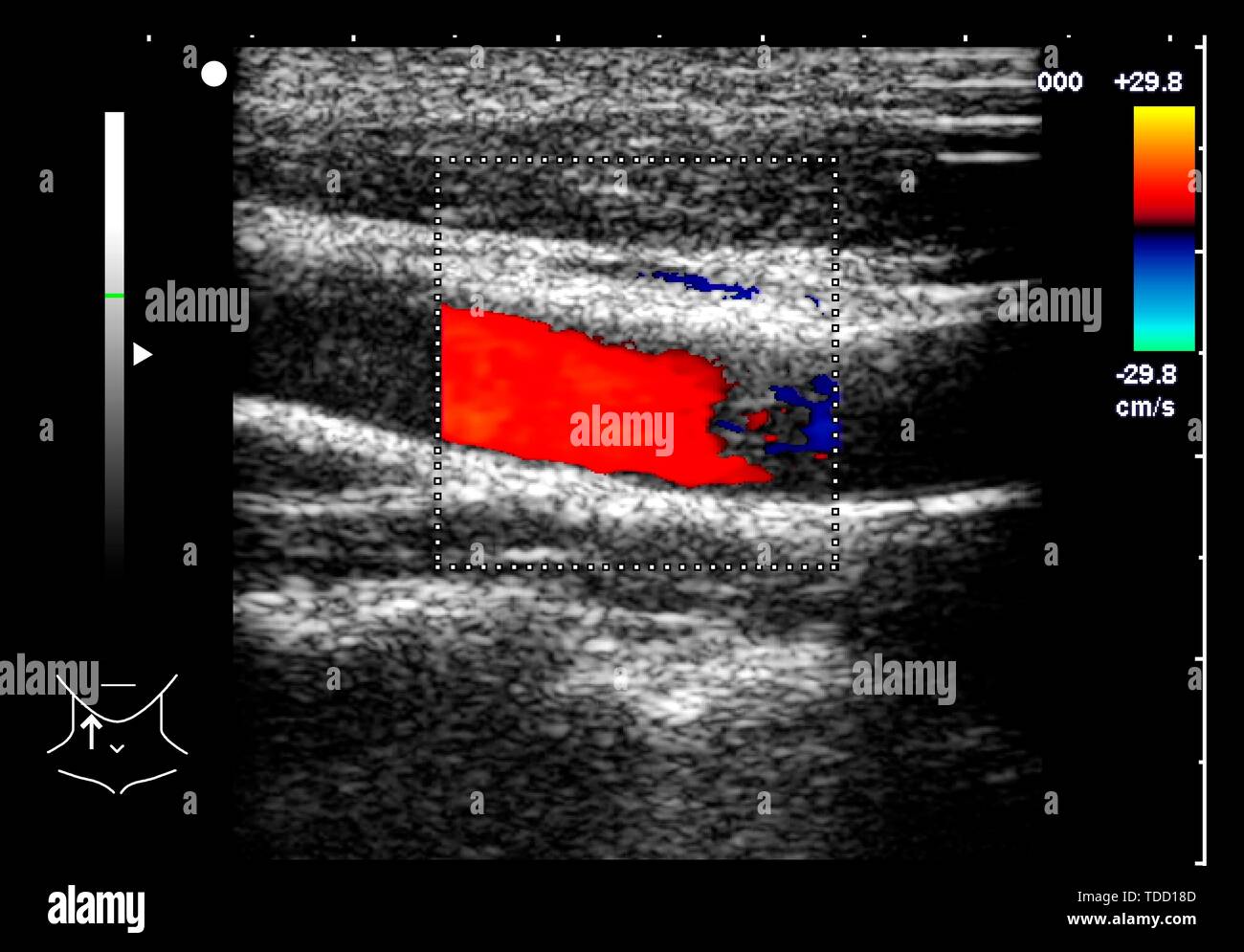 Carotid Arteries Ultrasound