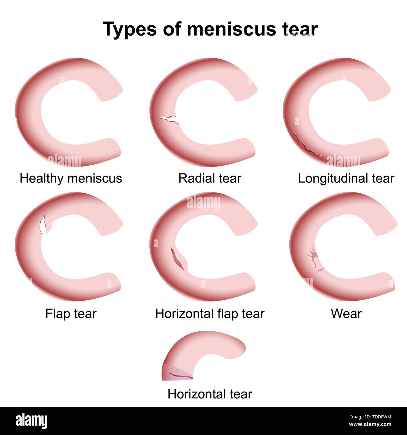 Meniscus injuries medical vector illustration isolated on white background, meniscus tear Stock Vector