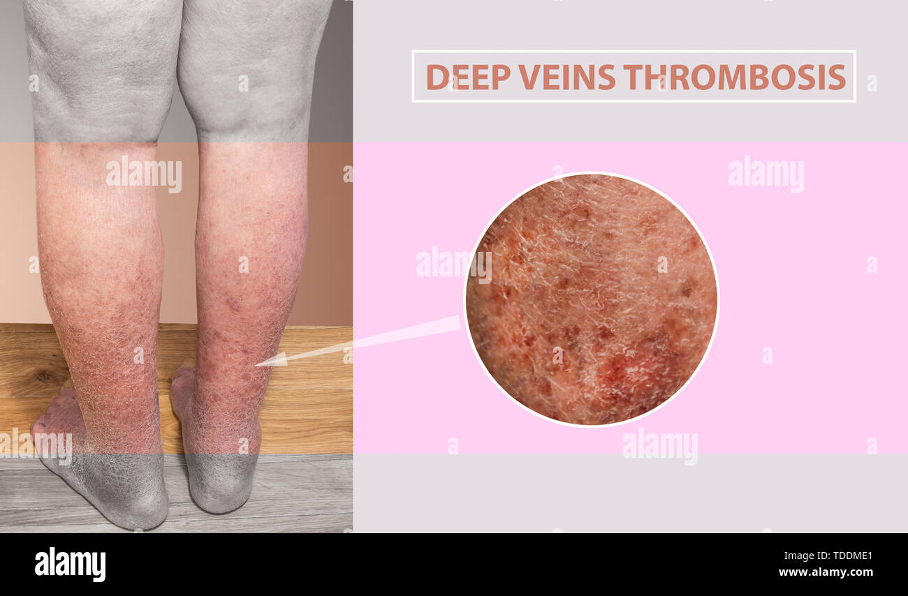 Blood Clots In Legs