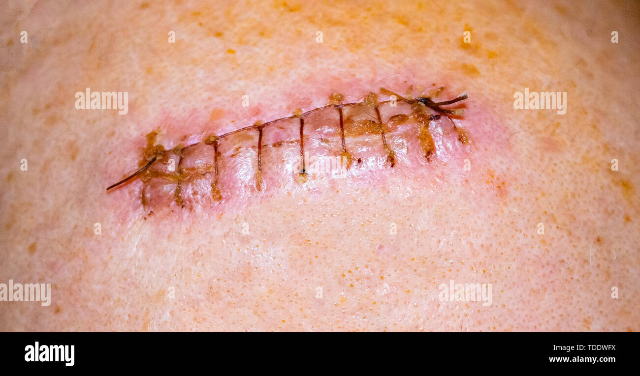Scar from surgery. Wound scar.The scar on the shoulder.Scar with thread. Stock Photo
